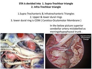 Oculomotor triangle is seen [ 3rd N. , 4th N. & Pcom ] seen in
Posterosuperior compartment [ virtual compartment ] of cavernous sinus –
better understanding see cavernous sinus PPT
http://www.slideshare.net/muralichandnallamothu/cavernous-sinus-360
 