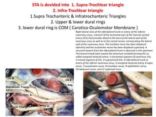 Antero-inferior compartment [ virtual compartment ] of cavernous sinus
– for better understanding see cavernous sinus PPT
http://www.slideshare.net/muralichandnallamothu/cavernous-sinus-360
1. The abducens nerve and the sympathetic plexus around the intracavernous carotid artery are the only
nerves which have a real intracavernous course.
2. The anteroinferior and lateral compartments contain the abducens nerve and, as surgical corridors, they
are exposed to the risk of injury to the VIth nerve.
BS basisphenoid, CS cavernous sinus, CSd dura of the cavernous sinus, ET eustachian tube, ICAc cavernous portion of the internal carotid
artery, ICAh horizontal portion of the internal carotid artery, ICAp parapharyngeal portion of the internal carotid artery, ILT inferolateral
trunk, LVPM levator veli palatini muscle, MHT meningohypophyseal trunk, PAp petrous apex, PCFd posterior cranial fossa dura and
periosteum, PG pituitary gland, TVPM tensor veli palatini muscle, VN vidian nerve, IIIcn oculomotor nerve, IVcn trochlear nerve, V1 fi rst
branch of the trigeminal nerve, V2 second branch of the trigeminal nerve, V3 third branch of the trigeminal nerve, VIcn abducens nerve,
XIIcn hypoglossal nerve, white asterisks sympathetic fi bres
connecting the VIcn
 