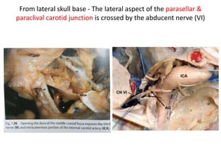 Cavernous Sinus Triangles
3. Supratrochlear (Paramedian) Triangle
· Borders:
1. Occulomotor Nerve
2. Trochlear Nerve
3. Tentorial Edge
· Contents:
1. Meningohypophyseal Trunk
4. Parkinson's (Infratrochlear) Triangle
· Borders:
1. Trochelar Nerve
Middle_fossa_triangles
Clinoidal (Anteromedial) Triangle 2
2. Opthalmic Division (V1)
3. Tentorial Edge
· Contents:
1. Cavernous ICA
2. Abducens Nerve
 