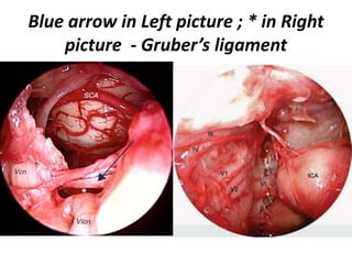 http://www.slideshare.net/INUB/endoscopic-anatomy-and-approaches-of-the-cavernous-sinus-
cadaver-study - Endoscopic view of the right cavernous sinus and neurovascular relations,
demonstrating the ‘S’ shaped configuration formed by the oculomotor, the abducens and the
vidian nerves. III oculomotor nerve, V1 ophthalmic nerve, V2 maxillary nerve, V3 mandibular nerve, VI
abducens nerve, C clivus, ICA-Sa anterior bend of the internal carotid artery–parasellar segment, ICA-Sp
posterior bend of the internal carotid artery–parasellar segment, ICA-C paraclival segment of the
internal carotid artery, ICA-L lacerum segment of the internal carotid artery, ICA-P petrous segment of
the internal carotid artery, PG pituitary gland, VC vidian canal, VN vidian nerve
6th nerve is parallel to V1 – in the
same direction of V1
 