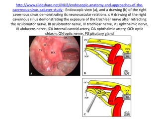 6th nerve is parallel to V1 – in the same direction of V1
 