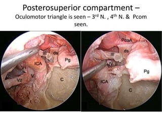 http://www.slideshare.net/INUB/endoscopic-anatomy-and-approaches-of-the-
cavernous-sinus-cadaver-study- Endoscopic view of the right cavernous sinus and its
neurovascular relations, demonstrating the triangular area formed by the medial
pterygoid process laterally, the parasellar ICA medially and the vidian nerve inferiorly
at the base. III oculomotor nerve, V1 ophthalmic nerve, V2 maxillary nerve, V3
mandibular nerve, VI abducens nerve, C clivus, ICA-Sa anterior bend of the internal
carotid artery–parasellar segment, ICA-Sp posterior bend of the internal carotid
artery–parasellar segment, ICA-C paraclival segment of the internal carotid artery, ICA-
L lacerum segment of the internal carotid artery, ICA-P petrous segment of the
internal carotid artery, PG pituitary gland, VC vidian canal, VN vidian nerve
 