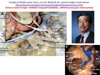 STA is devided into 1. Supra-Trochlear triangle
2. Infra-Trochlear triangle
1.Supra Trochanteric & Infratrochanteric Triangles
2. Upper & lower dural rings
3. lower dural ring is COM ( Carotico-Oculomotor Membrane )
In the below picture superior
cerebellar artery mislabelled as
meningohypophyseal trunk .
 