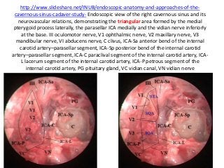 http://www.slideshare.net/INUB/endoscopic-anatomy-and-approaches-of-the-
cavernous-sinus-cadaver-study- Endoscopic view of the right cavernous sinus and its
neurovascular relations, demonstrating the triangular area formed by the medial
pterygoid process laterally, the parasellar ICA medially and the vidian nerve inferiorly
at the base. III oculomotor nerve, V1 ophthalmic nerve, V2 maxillary nerve, V3
mandibular nerve, VI abducens nerve, C clivus, ICA-Sa anterior bend of the internal
carotid artery–parasellar segment, ICA-Sp posterior bend of the internal carotid
artery–parasellar segment, ICA-C paraclival segment of the internal carotid artery, ICA-
L lacerum segment of the internal carotid artery, ICA-P petrous segment of the
internal carotid artery, PG pituitary gland, VC vidian canal, VN vidian nerve
 