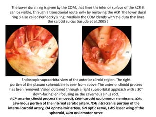 Schematic diagram of cavernous sinus roof
 