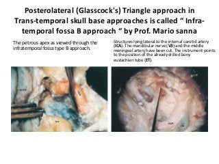 Posterolateral (Glasscock's) Triangle approach in
Trans-temporal skull base approaches is called “ Infra-
temporal fossa B approach “ by Prof. Mario sanna
The petrous apex as viewed through the
infratemporal fossa type B approach.
Structures lying lateral to the internal carotid artery
(ICA). The mandibular nerve (V3) and the middle
meningeal artery have been cut. The instrument points
to the position of the already drilled bony
eustachian tube (ET).
 
