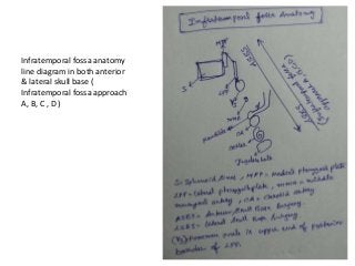 Infratemporal fossa anatomy
line diagram in both anterior
& lateral skull base (
Infratemporal fossa approach
A, B, C , D )
 