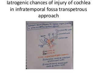 Iatrogenic chances of injury of cochlea
in infratemporal fossa transpetrous
approach
 