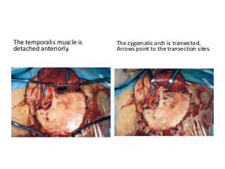 The temporalis muscle is
detached anteriorly.
The zygomatic arch is transected.
Arrows point to the transection sites.
 