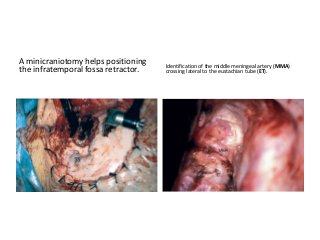 A minicraniotomy helps positioning
the infratemporal fossa retractor.
Identification of the middle meningeal artery (MMA)
crossing lateral to the eustachian tube (ET).
 