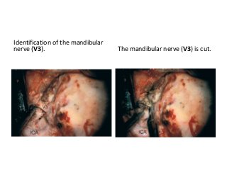 Identification of the mandibular
nerve (V3). The mandibular nerve (V3) is cut.
 