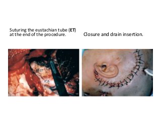 Suturing the eustachian tube (ET)
at the end of the procedure. Closure and drain insertion.
 