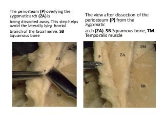 The periosteum (P) overlying the
zygomatic arch (ZA) is
being dissected away. This step helps
avoid the laterally lying frontal
branch of the facial nerve. SB
Squamous bone
The view after dissection of the
periosteum (P) from the
zygomatic
arch (ZA). SB Squamous bone, TM
Temporalis muscle
 
