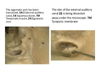 The zygomatic arch has been
transected. EAC External auditory
canal, SB Squamous bone, TM
Temporalis muscle, ZR Zygomatic
root
The skin of the external auditory
canal (S) is being dissected
away under the microscope. TM
Tympanic membrane
 