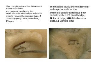 After complete removal of the external
auditory canal skin
and tympanic membrane, the
incudostapedial joint is disarticulated in
order to remove the ossicular chain. C
Chorda tympani, I Incus, M Malleus,
S Stapes
The mastoid cavity and the posterior
and superior walls of the
external auditory canal have been
partially drilled. FB Facial bridge,
FR Facial ridge, MFP Middle fossa
plate, SS Sigmoid sinus
 