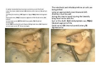 A radical mastoidectomy has been carried out, and the facial
nerve has been skeletonized. AR Anterior attic recess, C Basal turn
of the
cochlea (promontory), DR Digastric ridge, FN(m) Mastoid segment
of
the facial nerve, FN(t) Tympanic segment of the facial nerve, LSC
Lateral
semicircular canal, MFP Middle fossa plate, PSC Posterior
semicircular
canal, RW Round window, S Stapes, SS Sigmoid sinus, SSC Superior
semicircular canal, TT Tensor tympani
The retrofacial and infralabyrinthine air cells are
being drilled
using an appropriately sized diamond drill.
Attention must be paid
during this step to avoid injuring the laterally
lying facial nerve with the
burr or the shaft. ELS Endolymphatic sac, FN(m)
Mastoid segment of the
facial nerve, ICA Internal carotid artery, SS
Sigmoid sinus
 