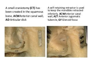 A small craniotomy (CT) has
been created in the squamous
bone. ACWAnterior canal wall,
AD Articular disk
A self-retaining retractor is used
to keep the mandible retracted
inferiorly. ACWAnterior canal
wall, AZT Anterior zygomatic
tubercle, GF Glenoid fossa
 