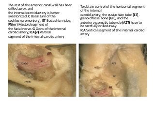 The rest of the anterior canal wall has been
drilled away, and
the internal carotid artery is better
skeletonized. C Basal turn of the
cochlea (promontory), ET Eustachian tube,
FN(m) Mastoid segment of
the facial nerve. G Genu of the internal
carotid artery, ICA(v) Vertical
segment of the internal carotid artery
To obtain control of the horizontal segment
of the internal
carotid artery, the eustachian tube (ET),
glenoid fossa bone (GF), and the
anterior zygomatic tubercle (AZT) have to
be carefully drilled away.
ICA Vertical segment of the internal carotid
artery
 