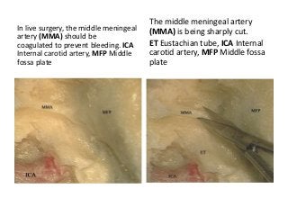 In live surgery, the middle meningeal
artery (MMA) should be
coagulated to prevent bleeding. ICA
Internal carotid artery, MFP Middle
fossa plate
The middle meningeal artery
(MMA) is being sharply cut.
ET Eustachian tube, ICA Internal
carotid artery, MFP Middle fossa
plate
 