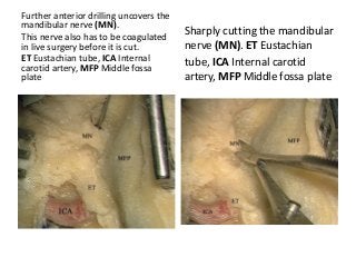 Further anterior drilling uncovers the
mandibular nerve (MN).
This nerve also has to be coagulated
in live surgery before it is cut.
ET Eustachian tube, ICA Internal
carotid artery, MFP Middle fossa
plate
Sharply cutting the mandibular
nerve (MN). ET Eustachian
tube, ICA Internal carotid
artery, MFP Middle fossa plate
 