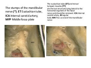 The stumps of the mandibular
nerve (*). ET Eustachian tube,
ICA Internal carotid artery,
MFP Middle fossa plate
The eustachian tube (ET) and tensor
tympani muscles (TT)
are the last structures lying lateral to the
horizontal segment of the facial
nerve and should be removed. ICA Internal
carotid artery, JB Jugular
bulb, MN The cut end of the mandibular
nerve
 