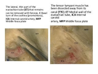 The lateral, thin part of the
eustachian tube (ET) that remains
can be removed with forceps. C Basal
turn of the cochlea (promontory),
ICA Internal carotid artery, MFP
Middle fossa plate
The tensor tympani muscle has
been dissected away from its
canal (TTC). ET Medial wall of the
eustachian tube, ICA Internal
carotid
artery, MFP Middle fossa plate
 