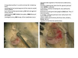 A large diamond burr is used to remove the remaining
bone
overlying the horizontal segment of the internal carotid
artery. C Basal
turn of the cochlea (promontory), ICA Vertical segment
of the internal
carotid artery, MFP Middle fossa plate, MMA Stump of
the middle
meningeal artery, MN Stump of the mandibular nerve
The horizontal segment of the internal carotid artery
(ICAh)
has been skeletonized. Note that the greater petrosal
nerve (GPN) is adherent
to the dura, and that retracting the dura will lead to
stress on the
facial nerve at the geniculate ganglion (GG) level. Thus, if
dural retraction
is needed, cutting the petrosal nerve will prevent this
injury. C Basal turn
of the cochlea (promontory), CL Clivus bone, G Genu,
ICA(v) Vertical
segment of the internal carotid artery
 