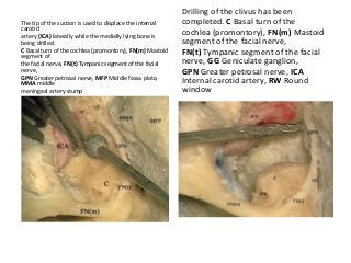 The tip of the suction is used to displace the internal
carotid
artery (ICA) laterally while the medially lying bone is
being drilled.
C Basal turn of the cochlea (promontory), FN(m) Mastoid
segment of
the facial nerve, FN(t) Tympanic segment of the facial
nerve,
GPN Greater petrosal nerve, MFP Middle fossa plate,
MMA middle
meningeal artery stump
Drilling of the clivus has been
completed. C Basal turn of the
cochlea (promontory), FN(m) Mastoid
segment of the facial nerve,
FN(t) Tympanic segment of the facial
nerve, GG Geniculate ganglion,
GPN Greater petrosal nerve, ICA
Internal carotid artery, RW Round
window
 