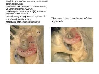 The full course of the intratemporal internal
carotid artery has
been freed. AFL Anterior foramen lacerum,
CF Carotid foramen, CL Dura
overlying the clivus area, ICA(h) Horizontal
segment of the internal
carotid artery, ICA(v) Vertical segment of
the internal carotid artery,
MN Stump of the mandibular nerve
The view after completion of the
approach.
 