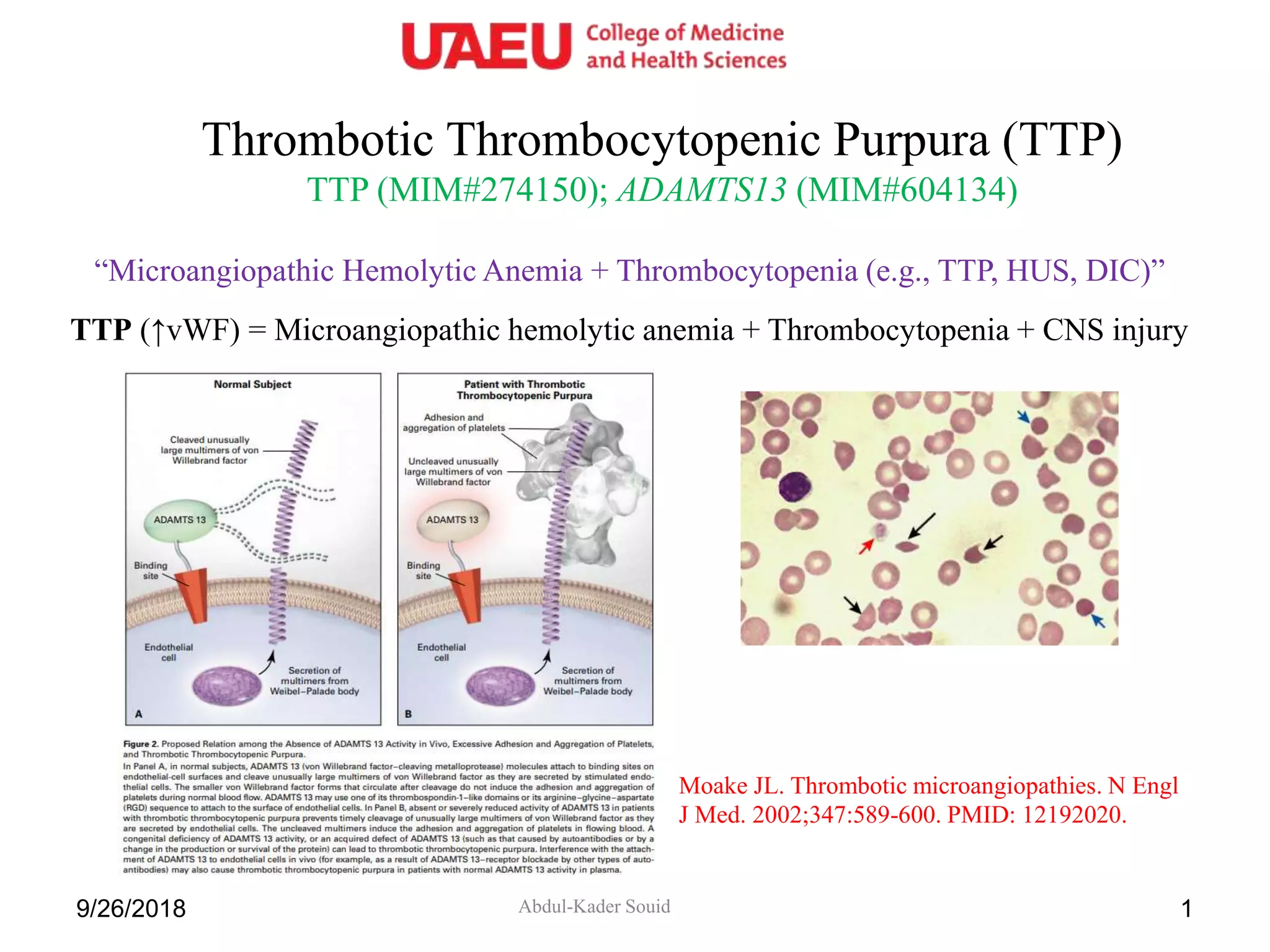 Thrombotic Thrombocytopenic Purpura (TTP)
TTP (MIM#274150); ADAMTS13 (MIM#604134)
Abdul-Kader Souid9/26/2018 1
“Microangiopathic Hemolytic Anemia + Thrombocytopenia (e.g., TTP, HUS, DIC)”
TTP (↑vWF) = Microangiopathic hemolytic anemia + Thrombocytopenia + CNS injury
Moake JL. Thrombotic microangiopathies. N Engl
J Med. 2002;347:589-600. PMID: 12192020.
 