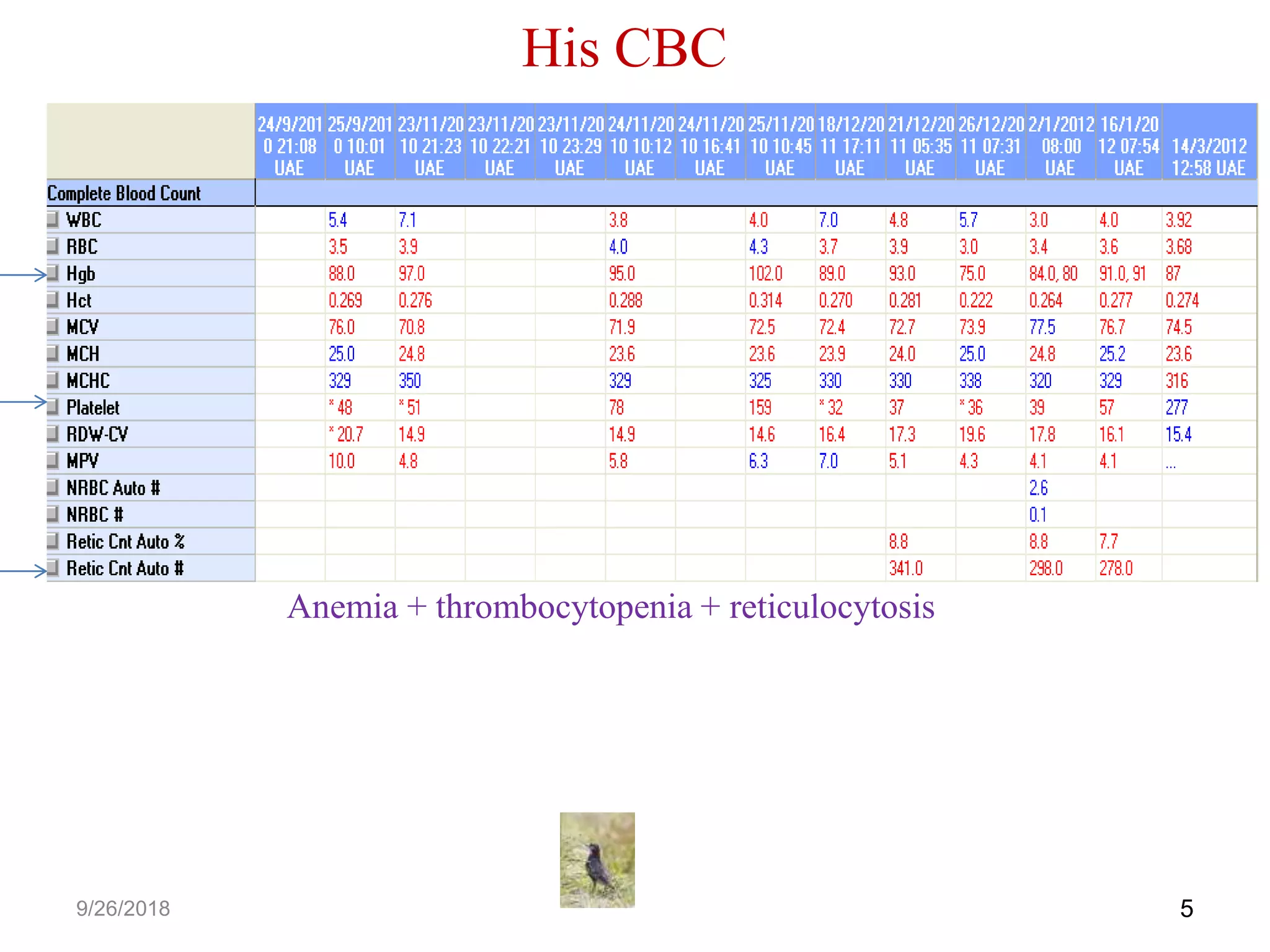 His CBC
59/26/2018
Anemia + thrombocytopenia + reticulocytosis
 