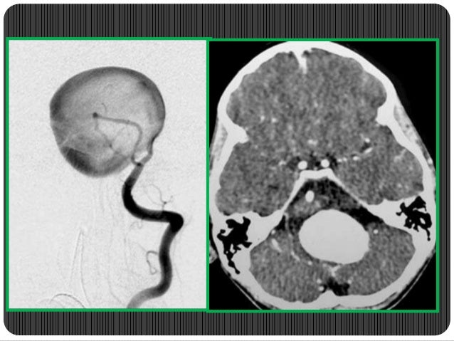 vascular brain lesions for radiology by dr soumitra halder