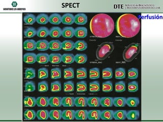 SPECT
Perfusión

 