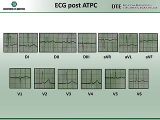 ECG post ATPC

DI

V1

DII

V2

DIII

V3

V4

aVR

aVL

V5

aVF

V6

 