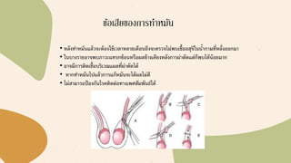 ข้อเสียของการทาหมัน
• หลังทาหมันแล้วจะต้องใช้เวลาหลายเดือนถึงจะตรวจไม่พบเชื้ออสุจิในน้ากามที่หลั่งออกมา
• ในบางรายอาจพบภาวะแทรกซ้อนหรือผลข้างเคียงหลังการผ่าตัดแต่ก็พบได้น้อยมาก
• อาจมีการติดเชื้อบริเวณแผลที่ผ่าตัดได้
• หากทาหมันไปแล้วการแก้หมันจะได้ผลไม่ดี
• ไม่สามารถป้องกันโรคติดต่อทางเพศสัมพันธ์ได้
 