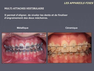 Les mini-vis en orthodontie, Dr Eric Ursat
