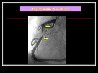 Angioplastía Percutánea
 