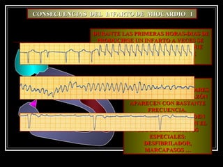 DURANTE LAS PRIMERAS HORAS-DIAS DEDURANTE LAS PRIMERAS HORAS-DIAS DE
PRODUCIRSE UN INFARTO A VECES SEPRODUCIRSE UN INFARTO A VECES SE
PRESENTAN COMPLICACIONES , QUEPRESENTAN COMPLICACIONES , QUE
PUEDEN SER POTENCIALMENTEPUEDEN SER POTENCIALMENTE
LETALESLETALES
LA PRESENCIA DELA PRESENCIA DE
ARRITMIAS VENTRICULARESARRITMIAS VENTRICULARES
O BLOQUEOS DEL CORAZÓNO BLOQUEOS DEL CORAZÓN
APARECEN CON BASTANTEAPARECEN CON BASTANTE
FRECUENCIA.FRECUENCIA.
POR LO GENERAL PUEDENPOR LO GENERAL PUEDEN
SER CONTROLADOS CON ELSER CONTROLADOS CON EL
USO DE DISPOSITIVOSUSO DE DISPOSITIVOS
ESPECIALES:ESPECIALES:
DESFIBRILADOR,DESFIBRILADOR,
MARCAPASOS …MARCAPASOS …
CONSECUENCIAS DEL INFARTO DE MIOCARDIO ICONSECUENCIAS DEL INFARTO DE MIOCARDIO I
 