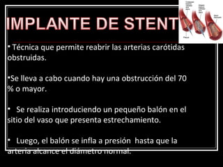 • Técnica que permite reabrir las arterias carótidas
obstruidas.
•Se lleva a cabo cuando hay una obstrucción del 70
% o mayor.
• Se realiza introduciendo un pequeño balón en el
sitio del vaso que presenta estrechamiento.
• Luego, el balón se infla a presión hasta que la
arteria alcance el diámetro normal.
 