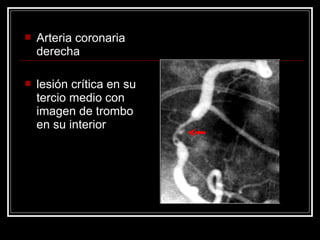  Arteria coronaria
derecha
 lesión crítica en su
tercio medio con
imagen de trombo
en su interior
 