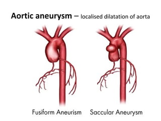 Aortic aneurysm – localised dilatation of aorta
 