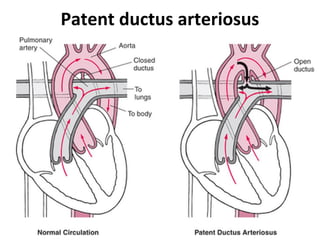 Patent ductus arteriosus
 