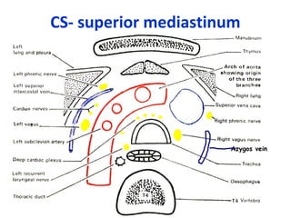 Azygos vein
TS at T4 V level
CS- superior mediastinum
 