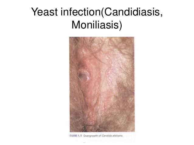 moniliasis