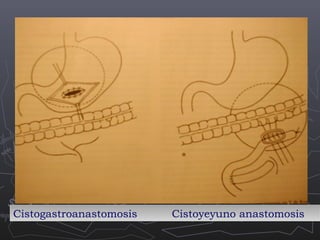 Cistogastroanastomosis
Cistogastroanastomosis

Cistoyeyuno anastomosis
Cistoyeyuno anastomosis

 