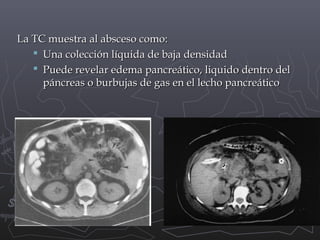 La TC muestra al absceso como:
 Una colección líquida de baja densidad
 Puede revelar edema pancreático, liquido dentro del
páncreas o burbujas de gas en el lecho pancreático

 