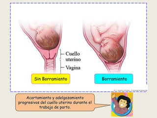 Sin Borramiento

Acortamiento y adelgazamiento
progresivos del cuello uterino durante el
trabajo de parto.

Borramiento

 