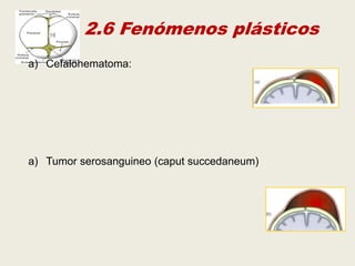2.6 Fenómenos plásticos
a) Cefalohematoma:

a) Tumor serosanguineo (caput succedaneum)

 