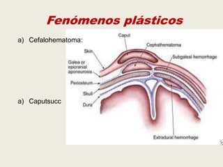 Fenómenos plásticos
a) Cefalohematoma:

a) Caputsucc

 