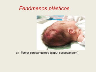 Fenómenos plásticos

a) Tumor serosanguineo (caput succedaneum)

 